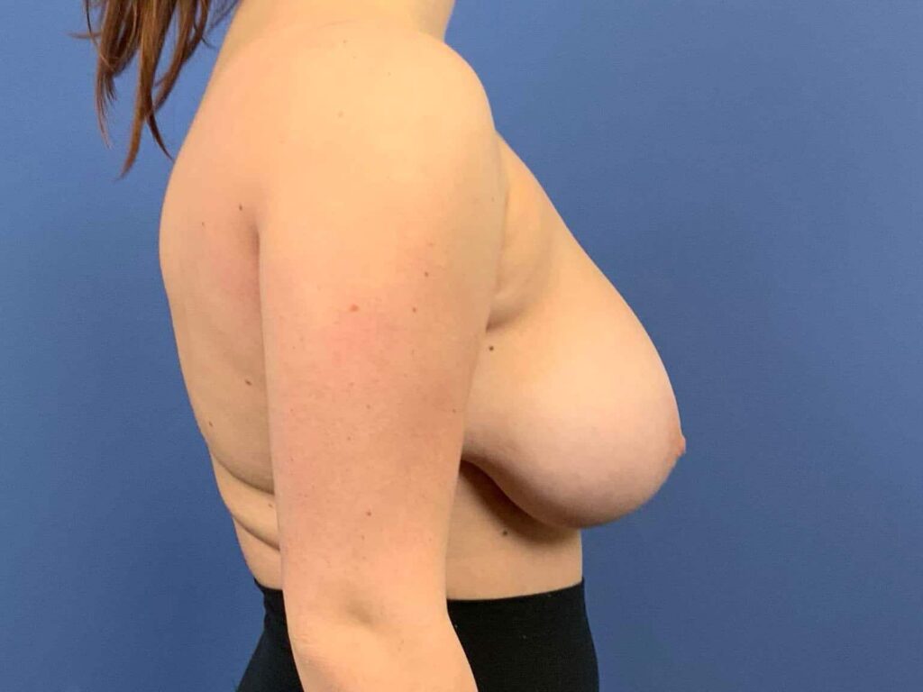 Before Image:  - right-side