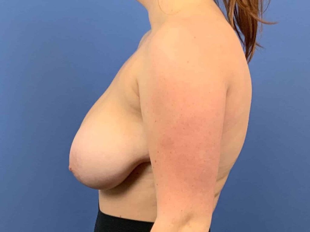 Before Image:  - left-side