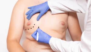 Plastic surgeon marking up man's chest to prepare for male breast reduction.