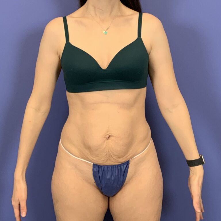 Before Image: tummy tuck - front