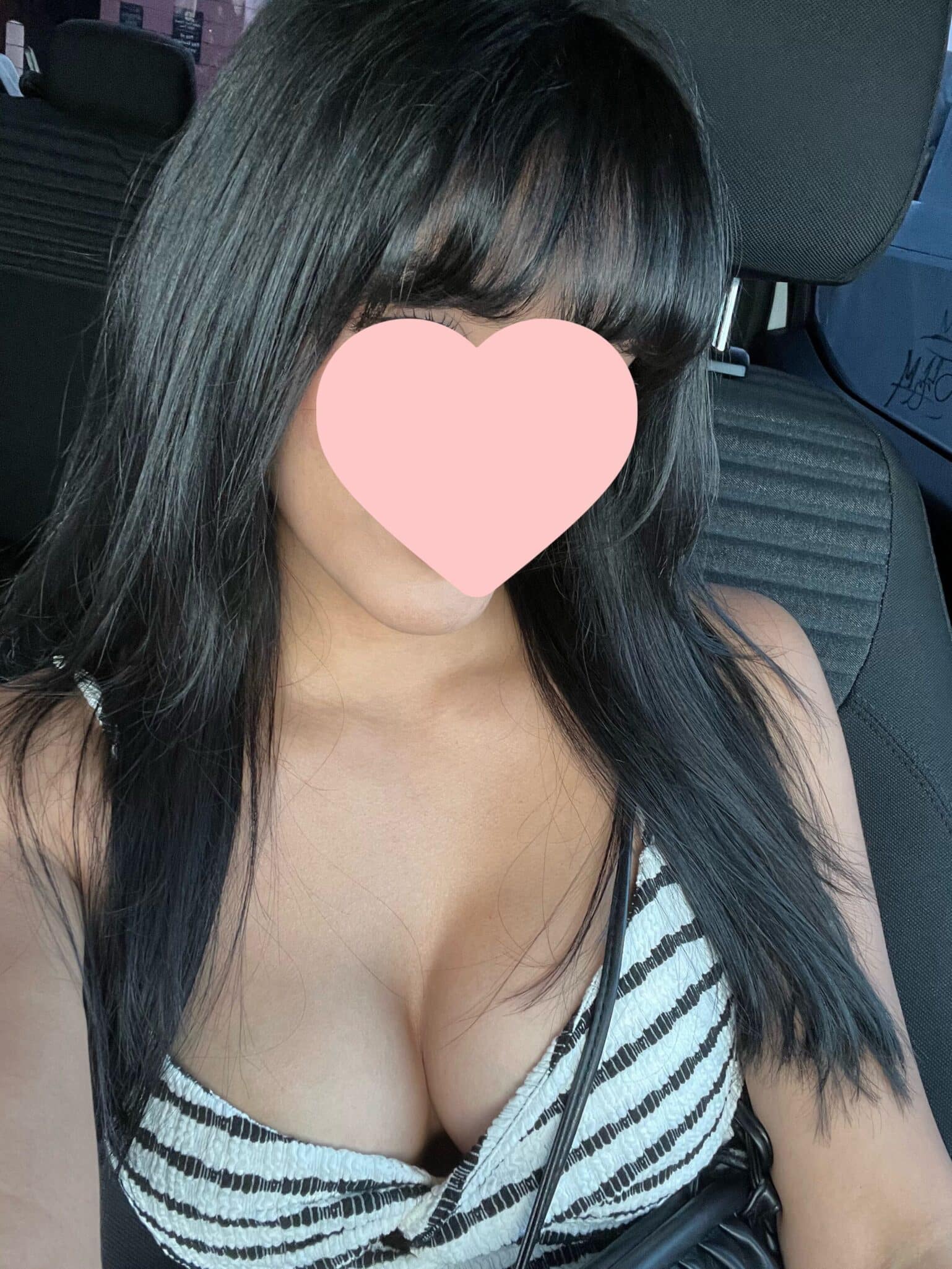 After Image: Breast augmentation - front