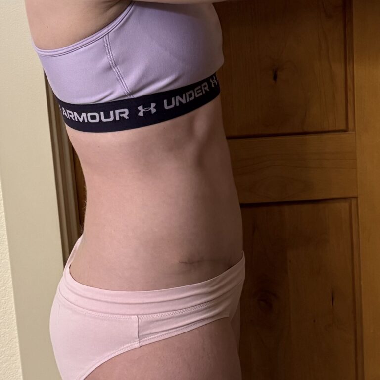 After Image: tummy tuck - right-side