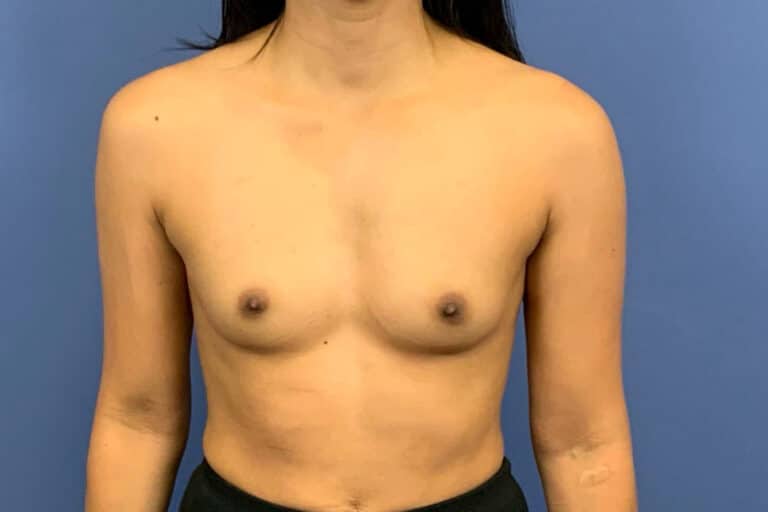 Before Image: Breast augmentation - front