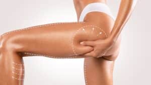 Close-up of a woman pinching her upper thigh with marked lines indicating cellulite treatment areas.