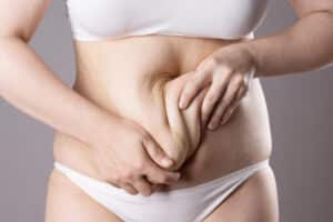 Woman pulling on excessively loose skin around her midsection and considering a tummy tuck.