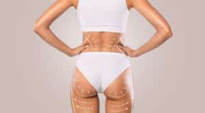 Image of woman's backside with lines on obliques, buttocks and thighs to indicate liposuction areas.