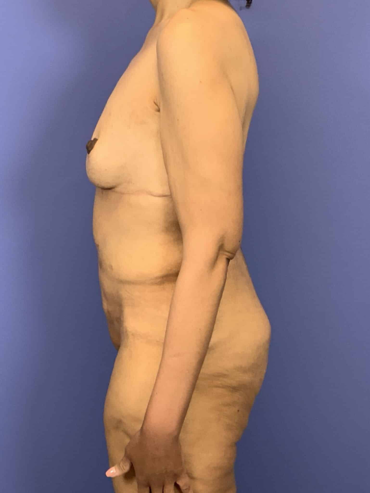 After Image:  - left-side