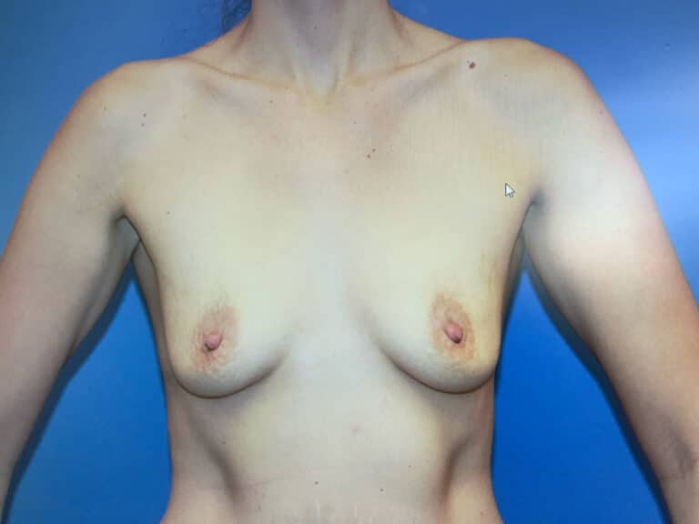 Before Image:  - front