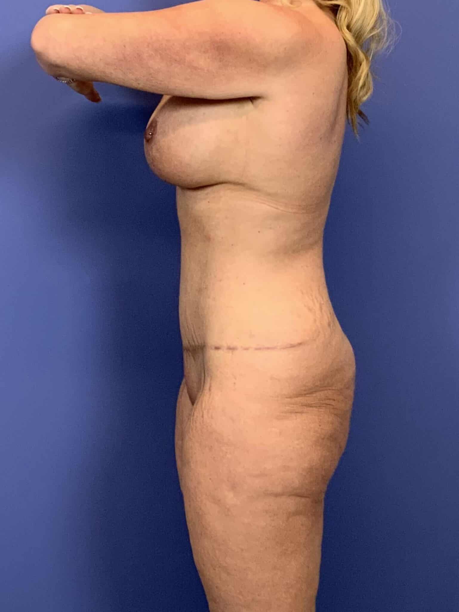 After Image:  - left-side