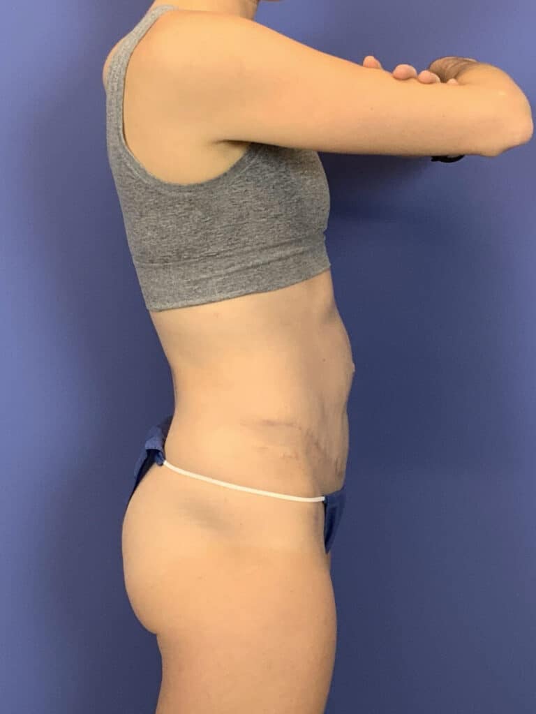 After Image:  - right-side