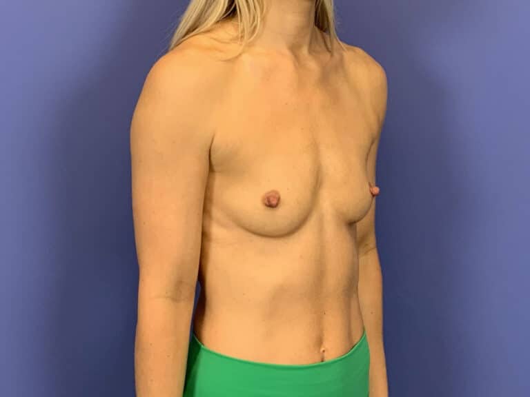 Before Image:  - right-front-oblique