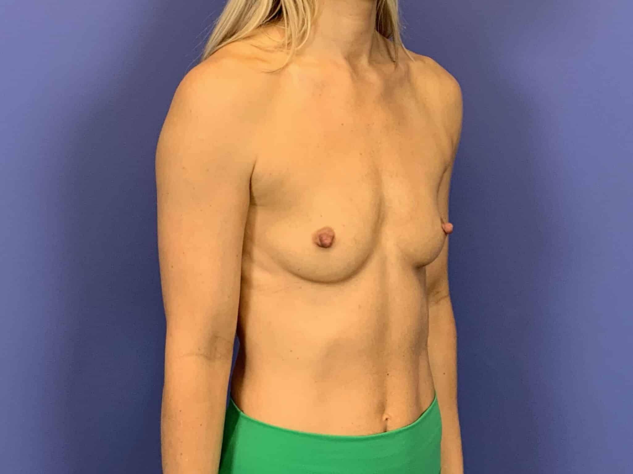 Before Image:  - right-front-oblique