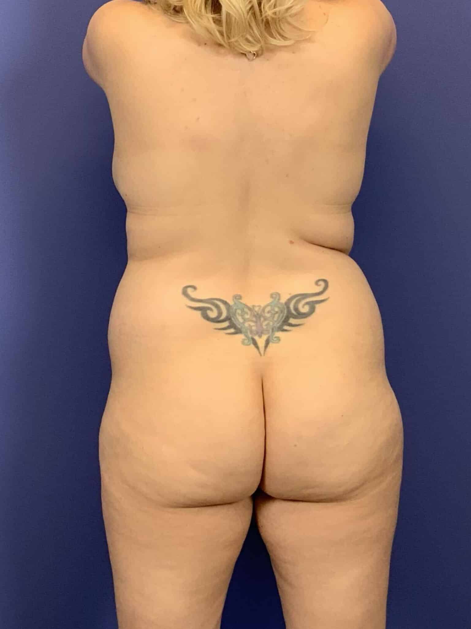 Before Image:  - back