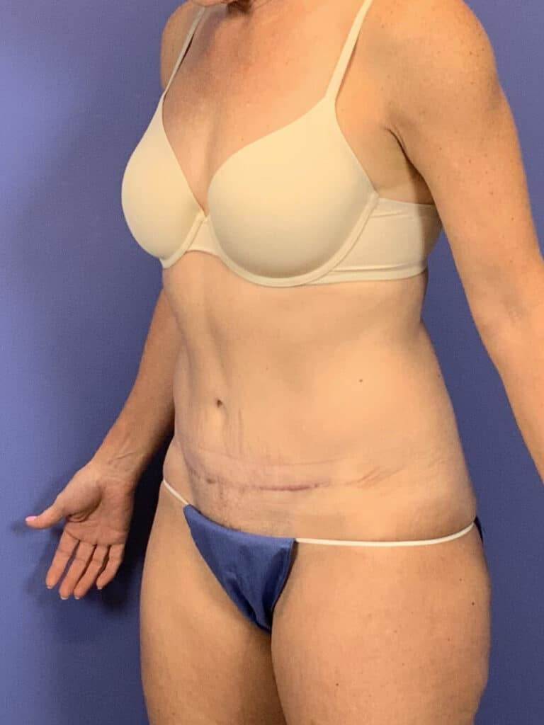 After Image:  - left-front-oblique