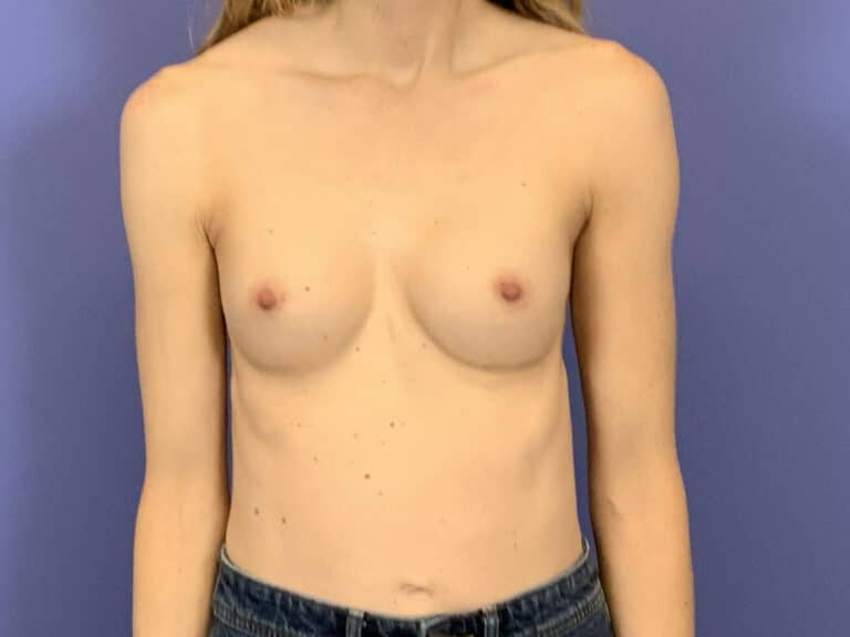 After Image:  - front