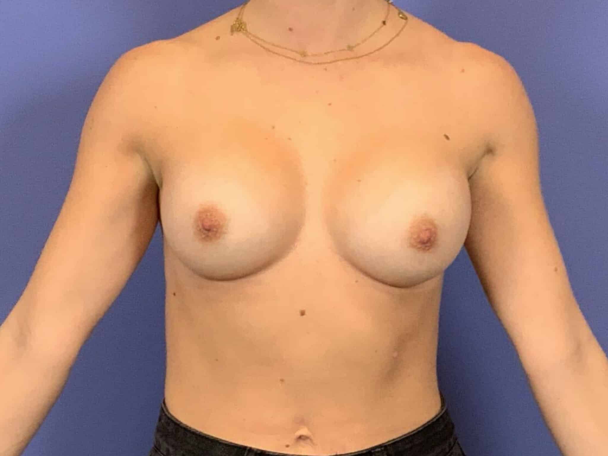 After Image:  - front