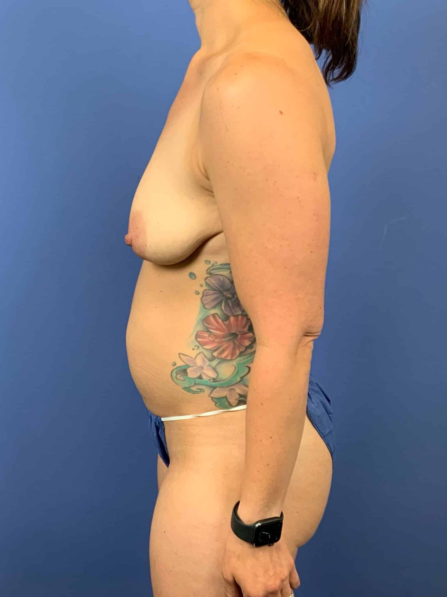 Before Image:  - left-side