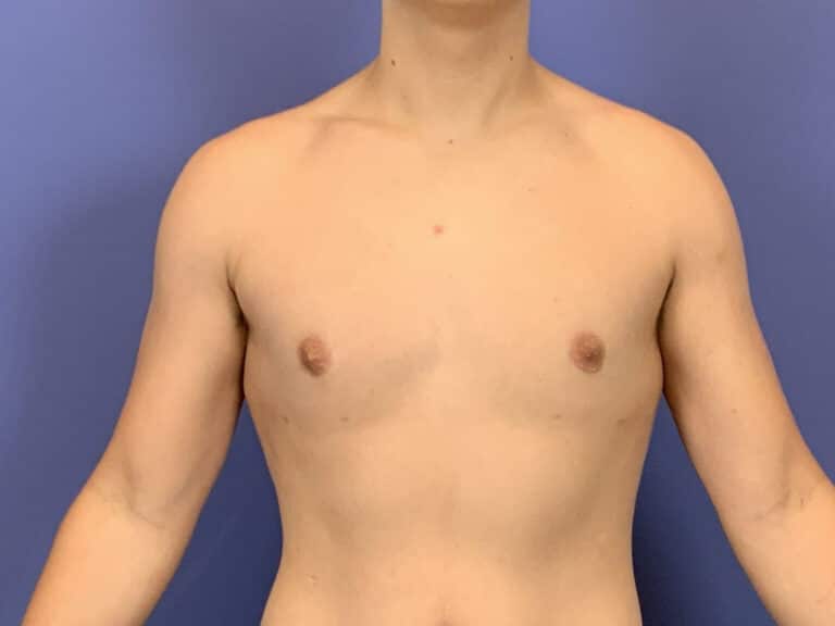 After Image:  - front