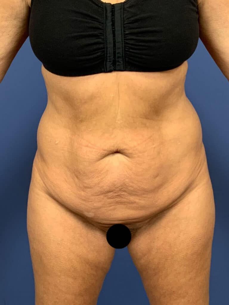 Before Image:  - front