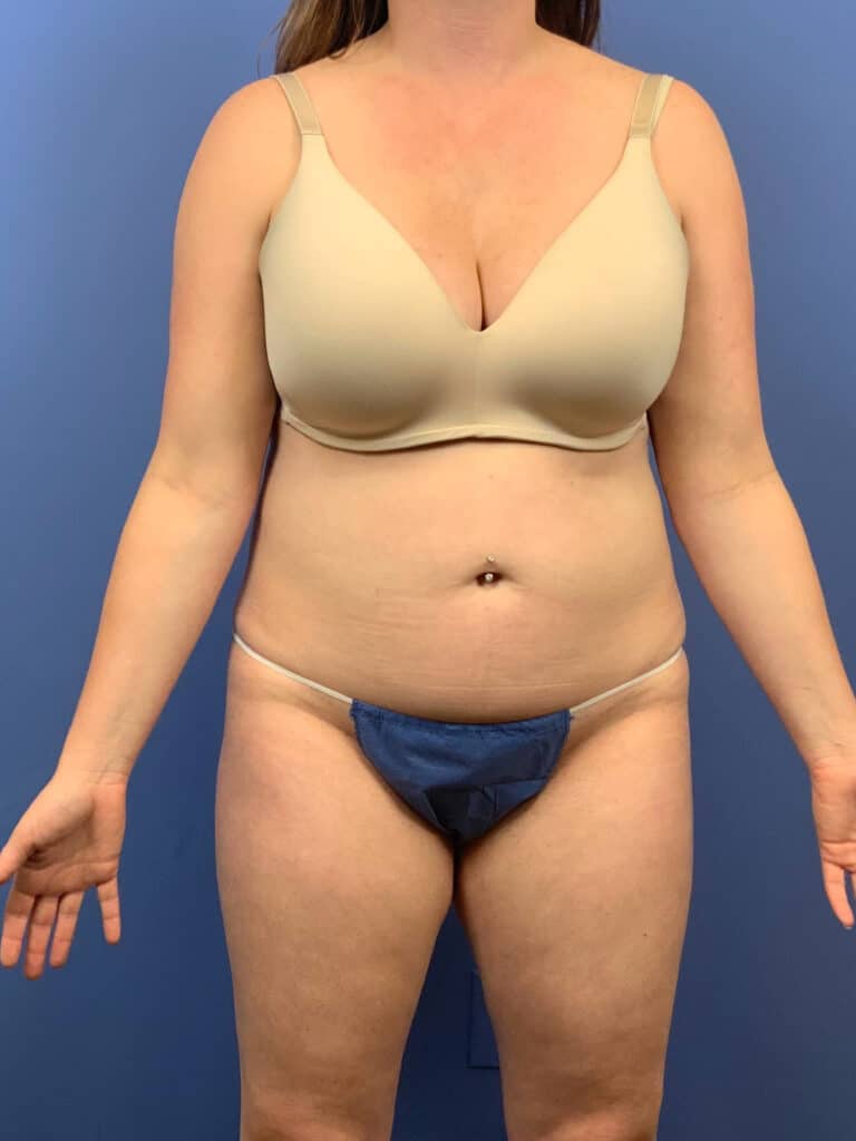 Before Image:  - front