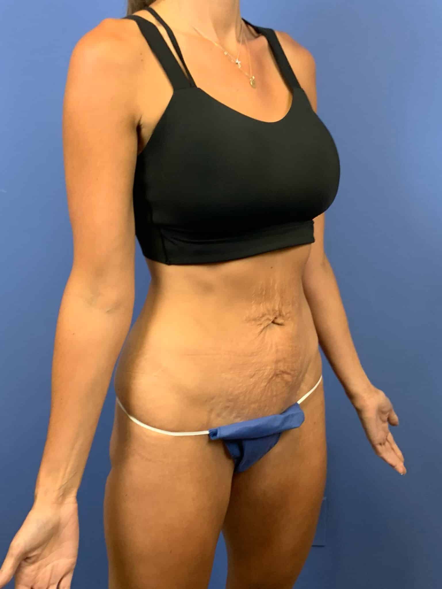Before Image:  - front