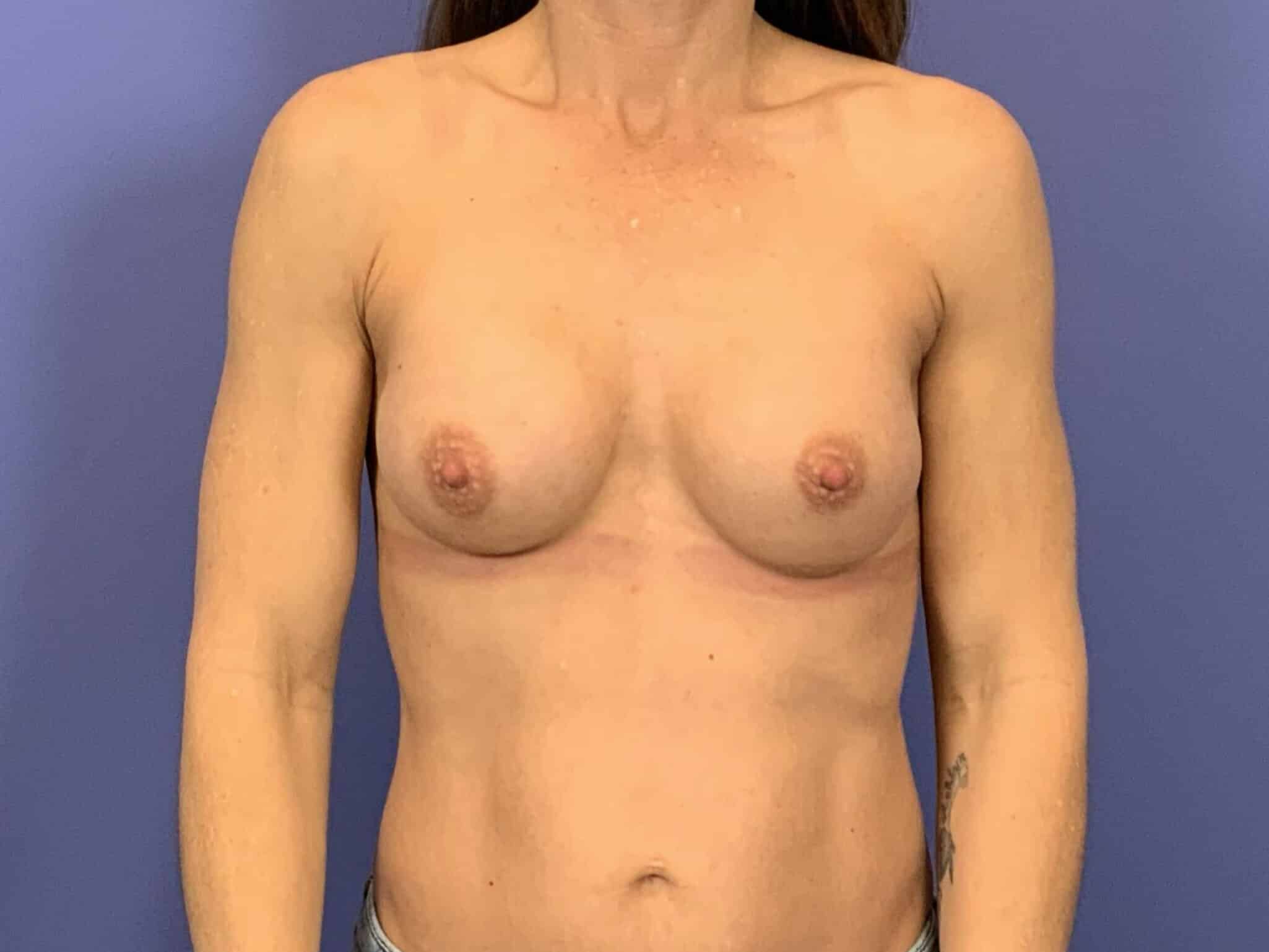 After Image:  - front