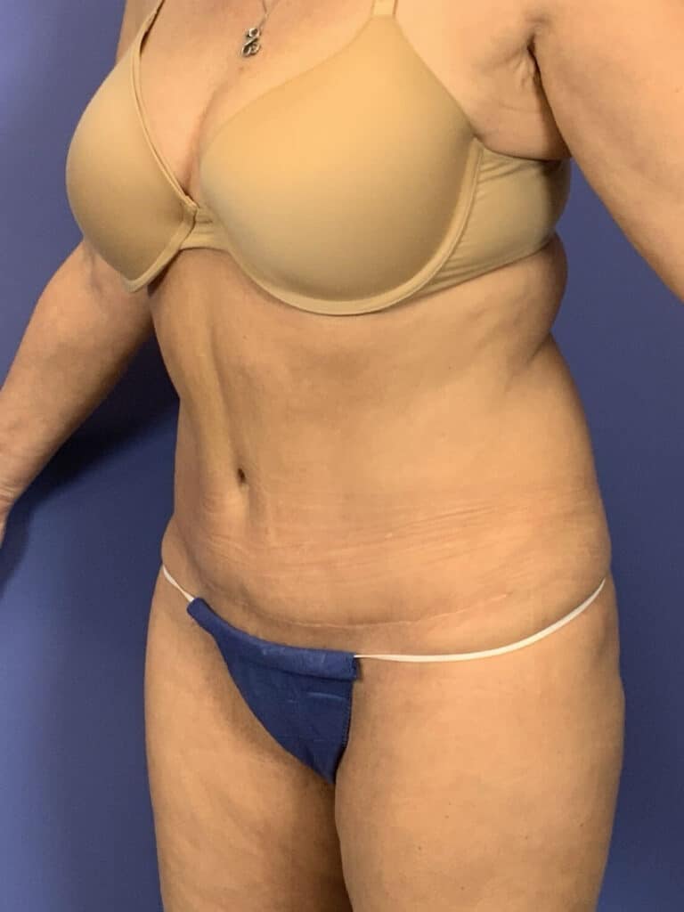 After Image:  - left-front-oblique