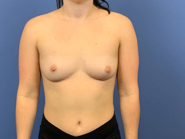 Before Image:  - front