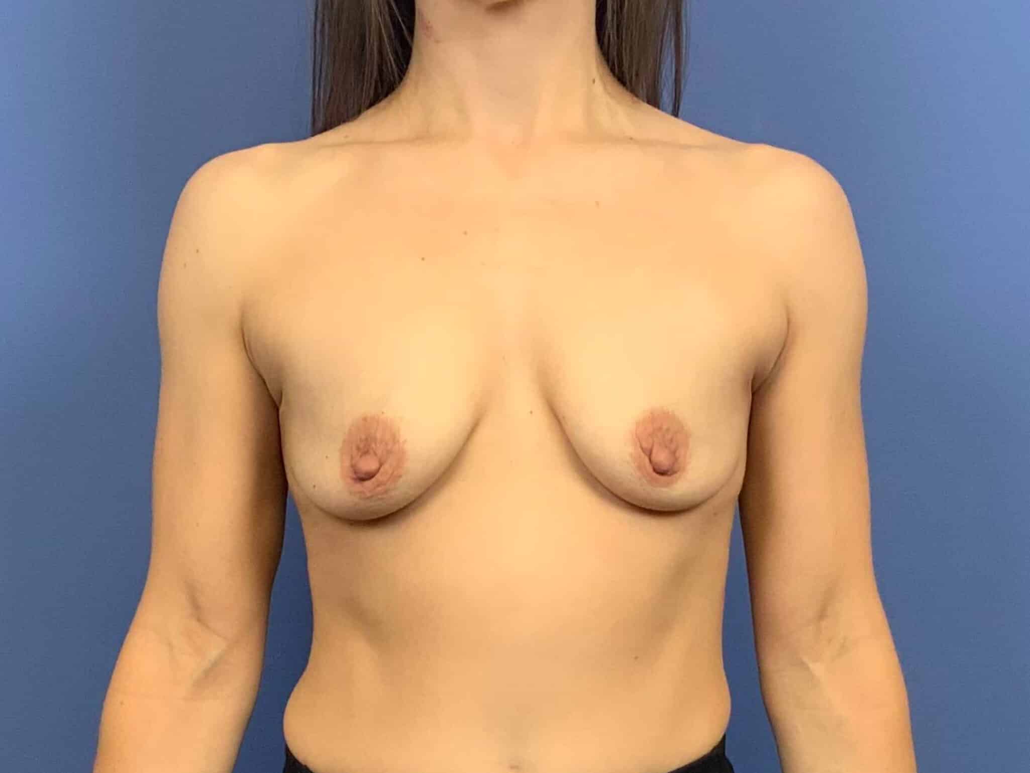 Before Image:  - front