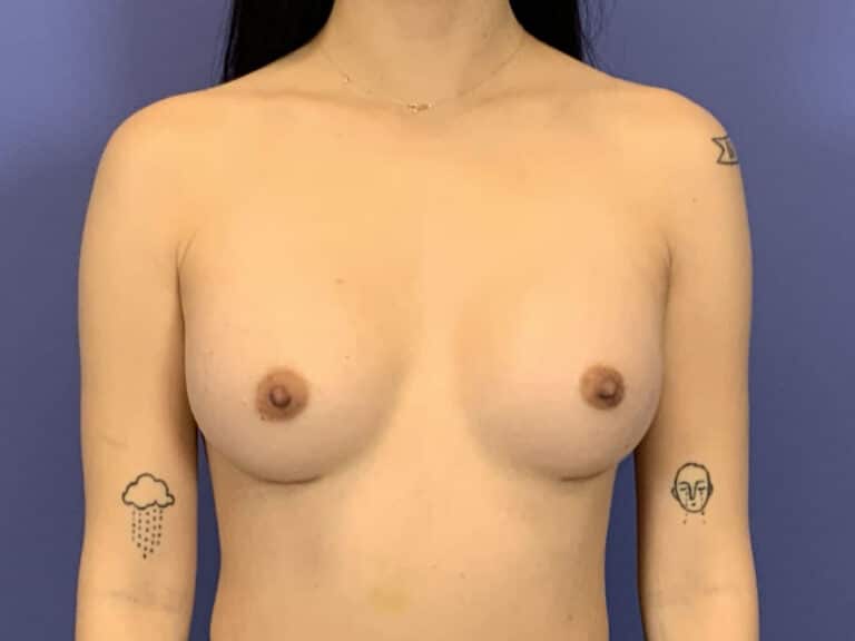 After Image:  - front