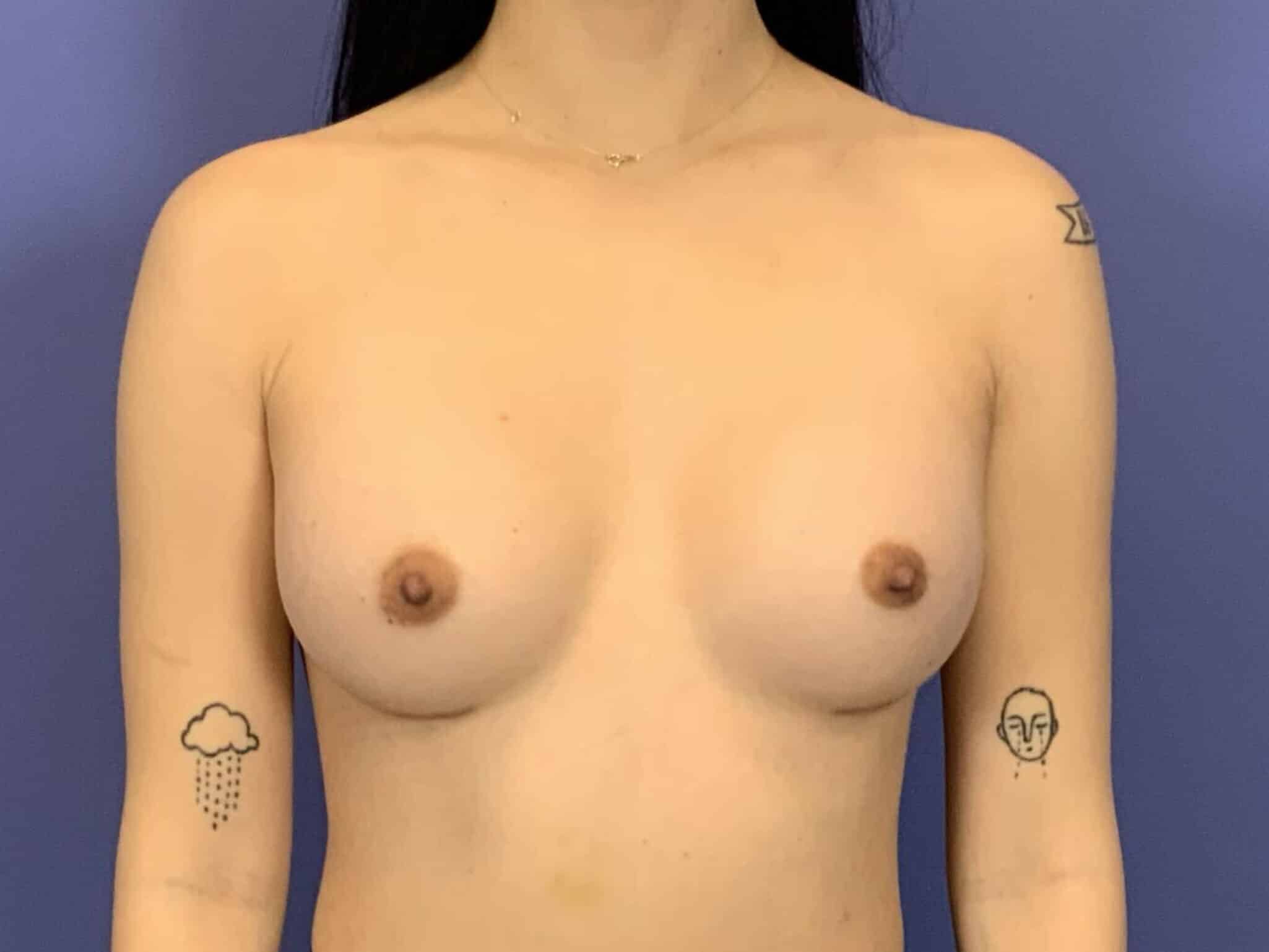 After Image:  - front
