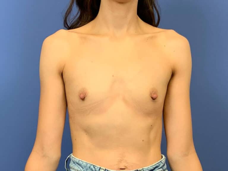 Before Image:  - front