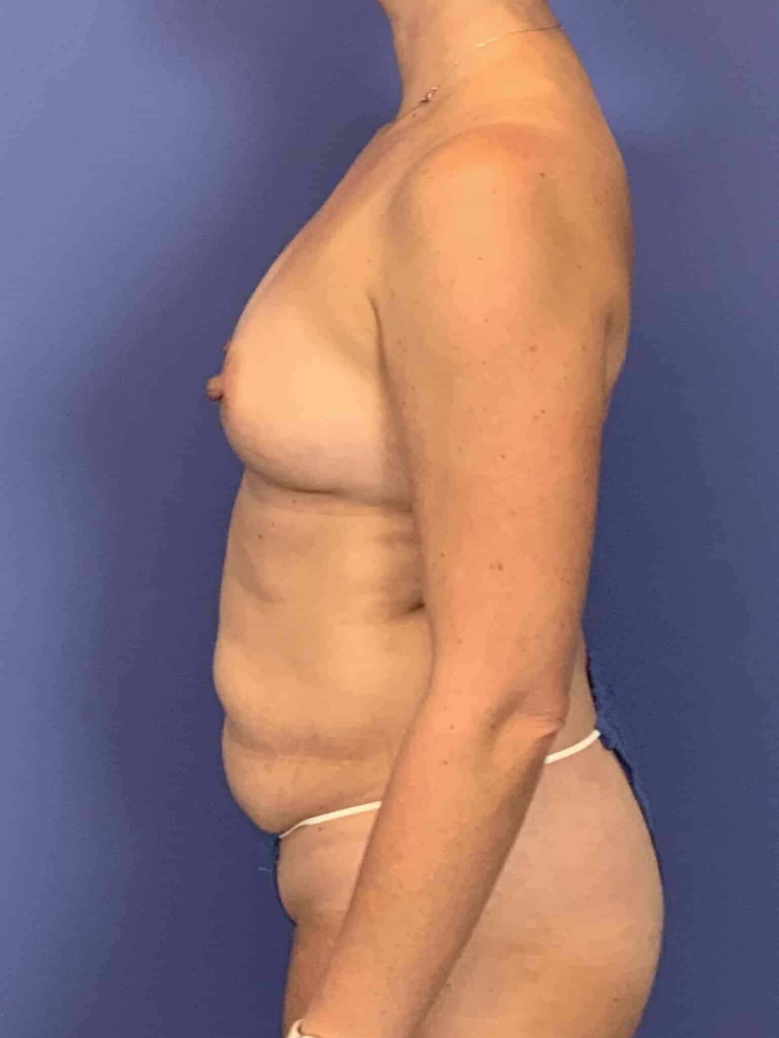 Before Image:  - left-side