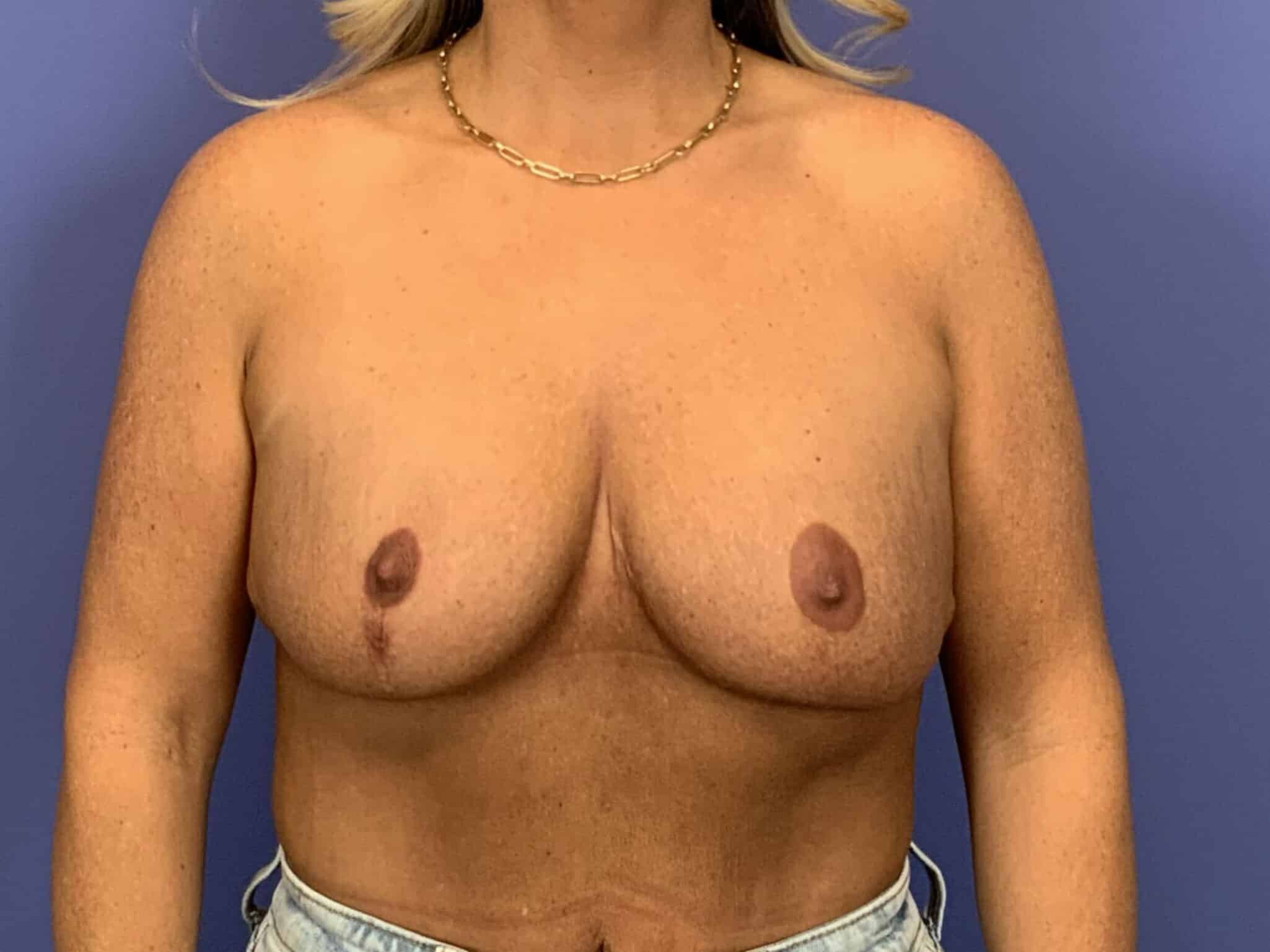 Before Image:  - front