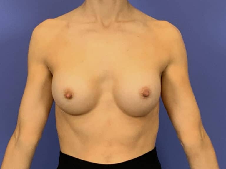 After Image:  - front