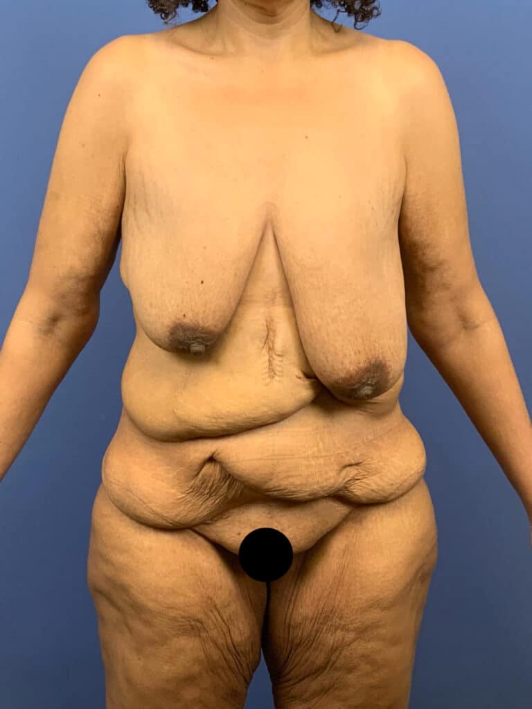 Before Image:  - front