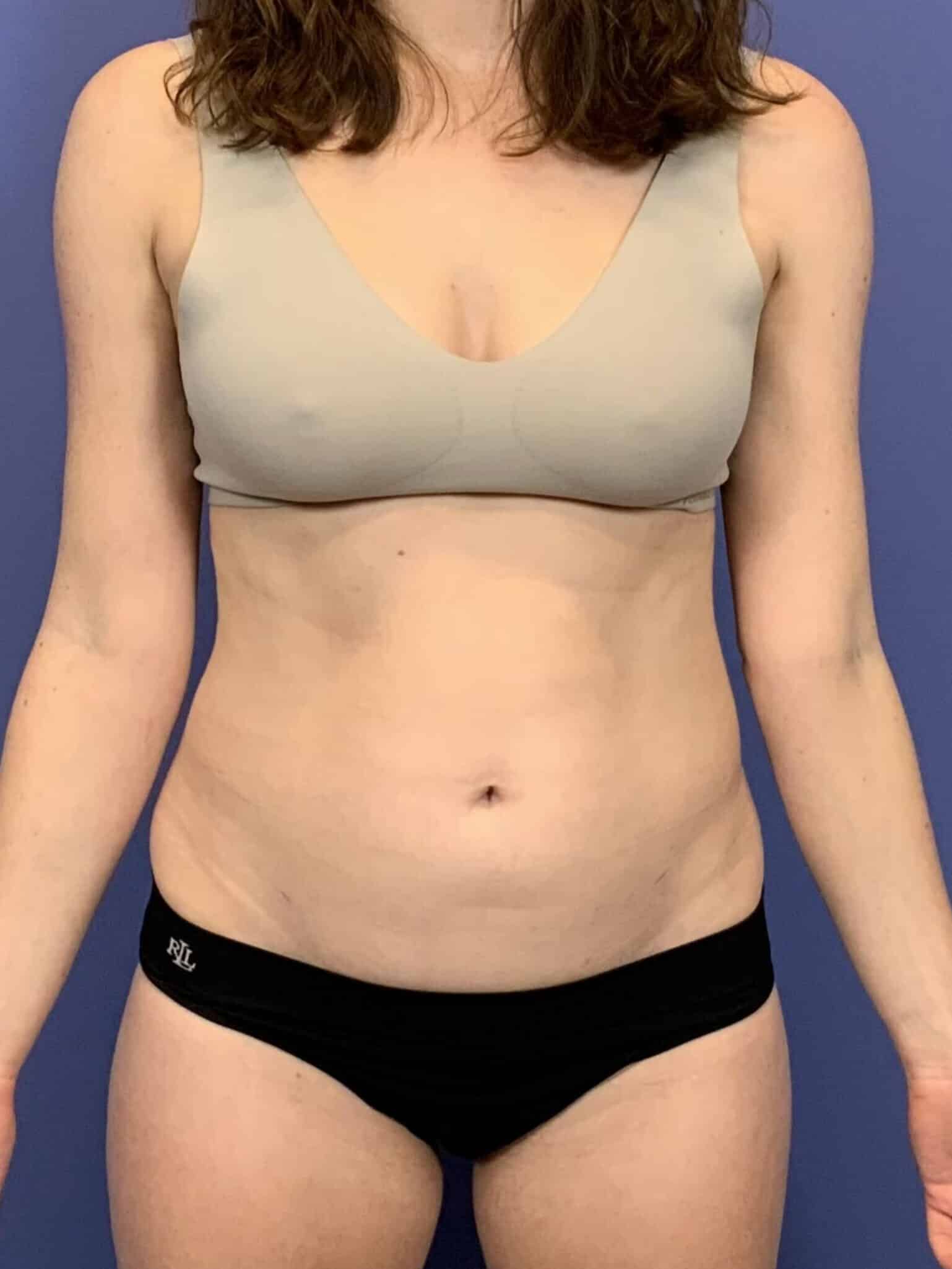 Before Image:  - front