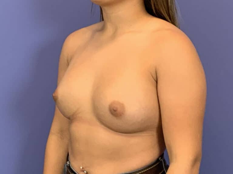 After Image:  - left-front-oblique