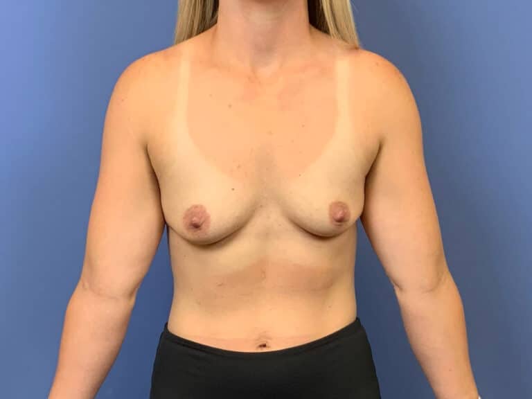 Before Image:  - front