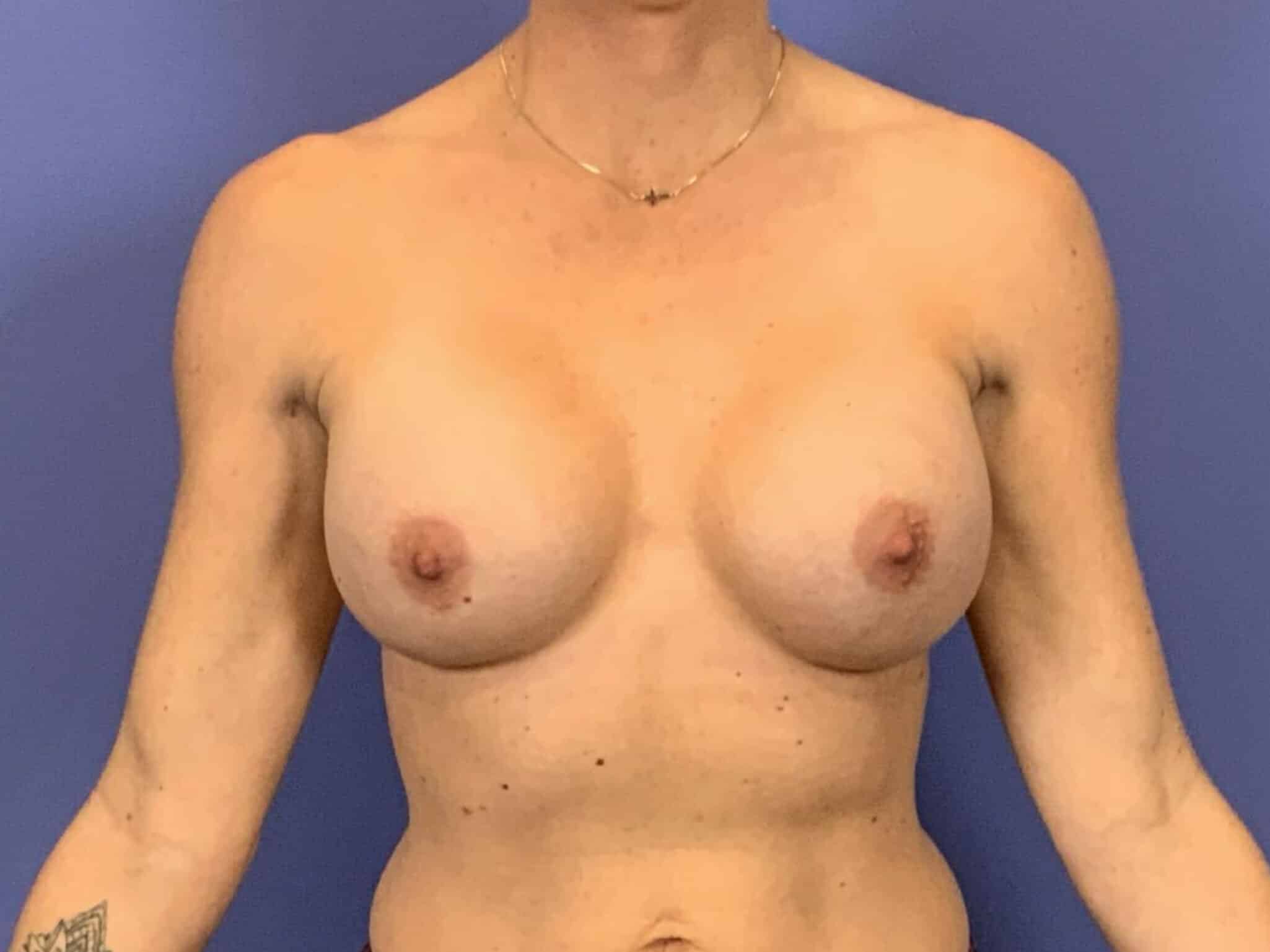 After Image:  - front