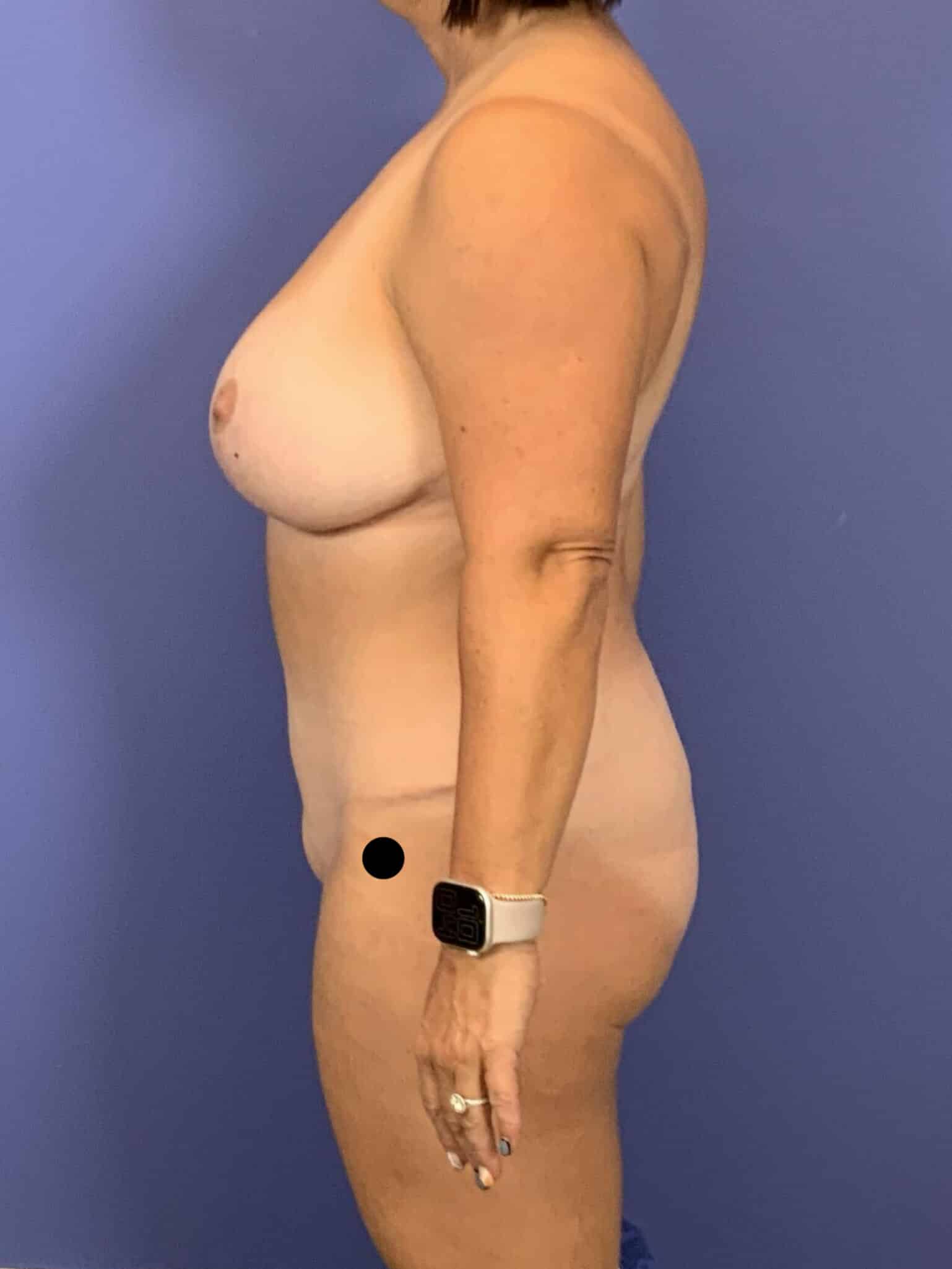 After Image:  - left-side