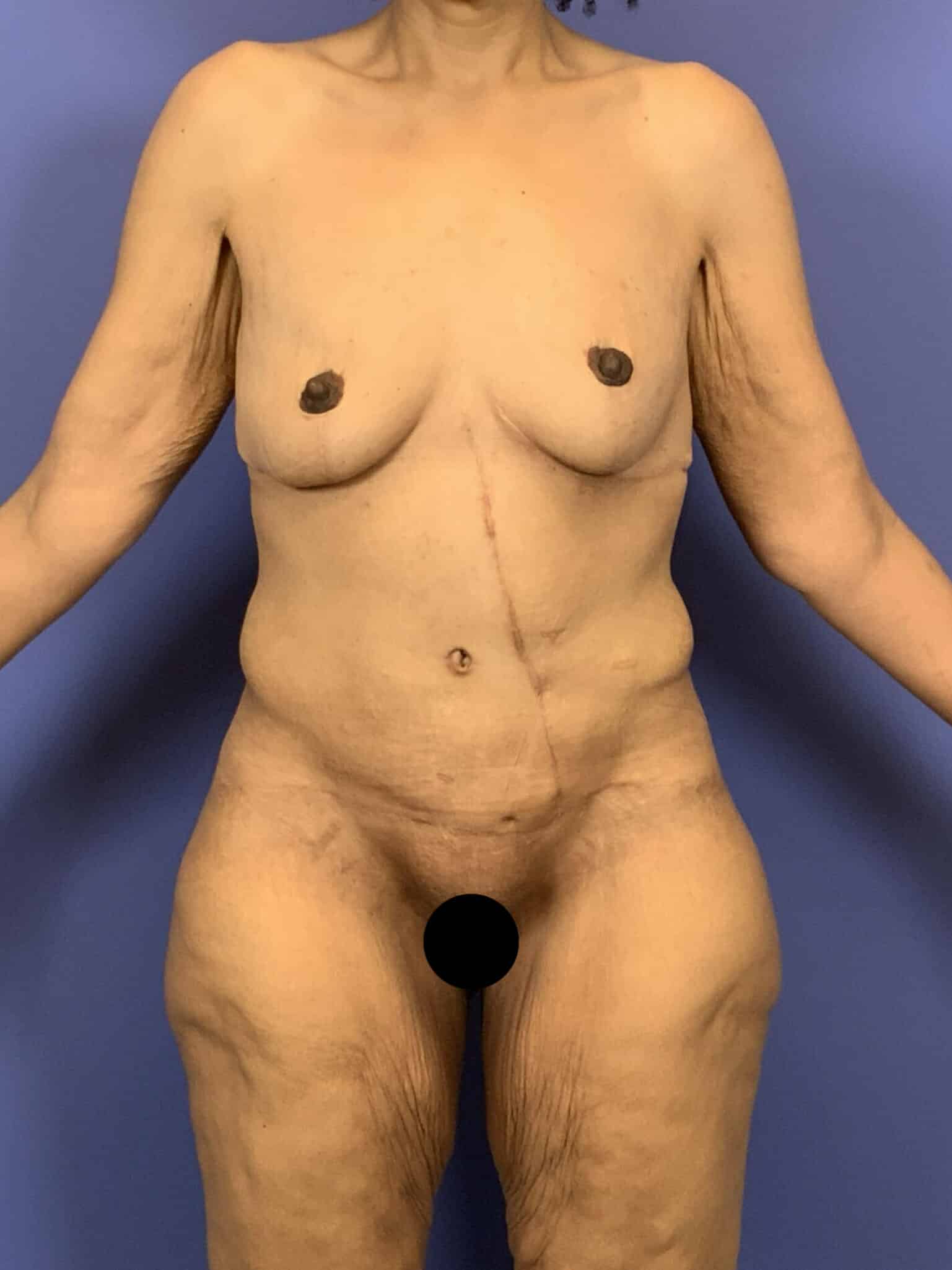 After Image:  - front