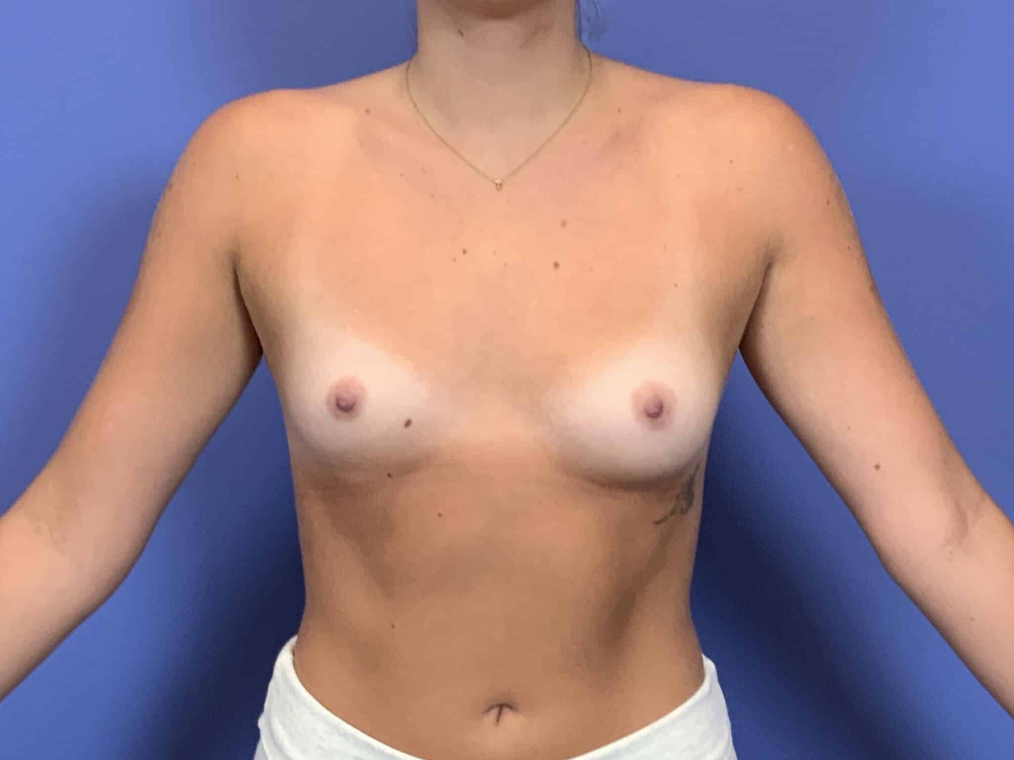 Before Image:  - front