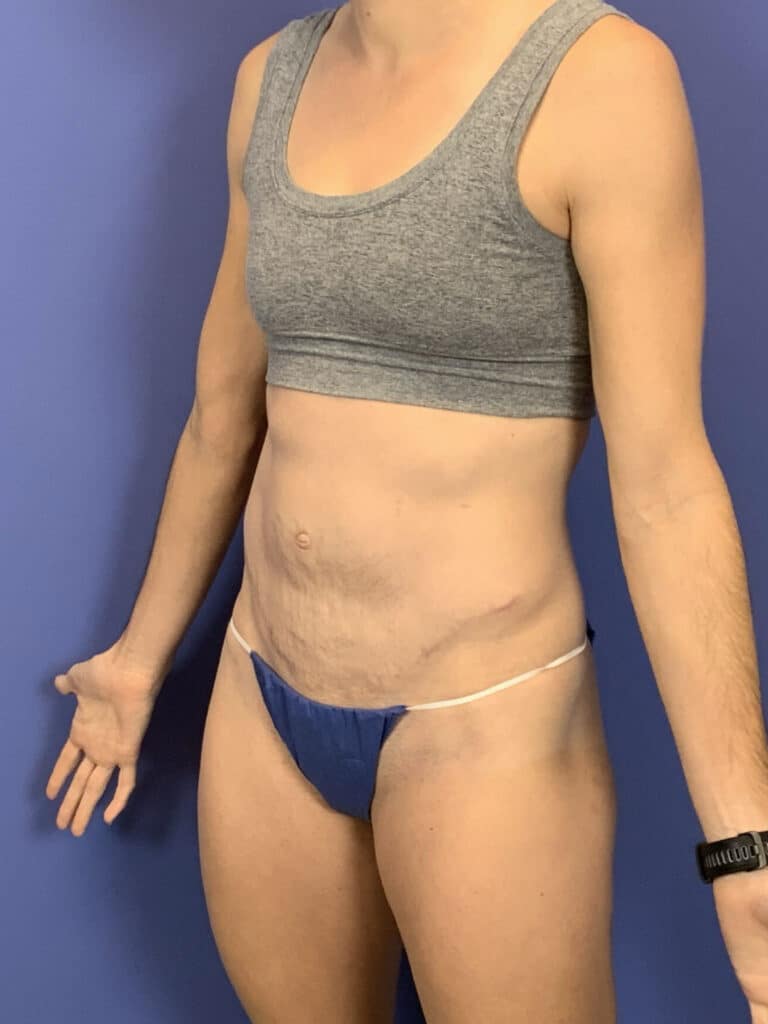 After Image:  - left-front-oblique