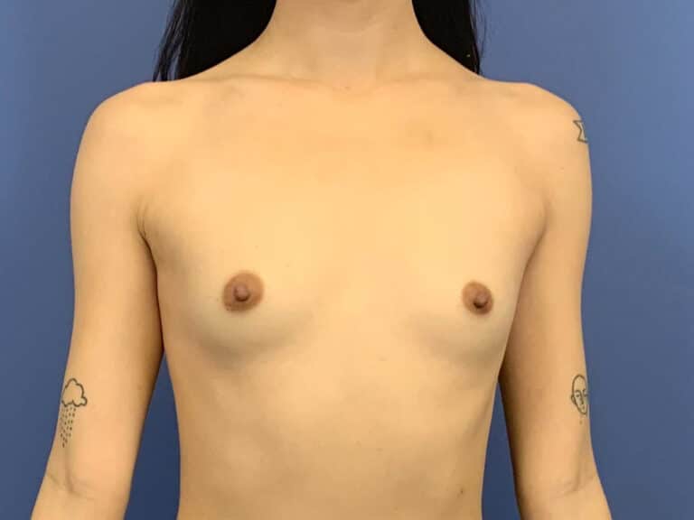 Before Image:  - front