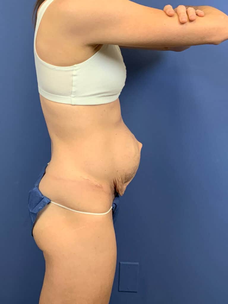 Before Image:  - right-side