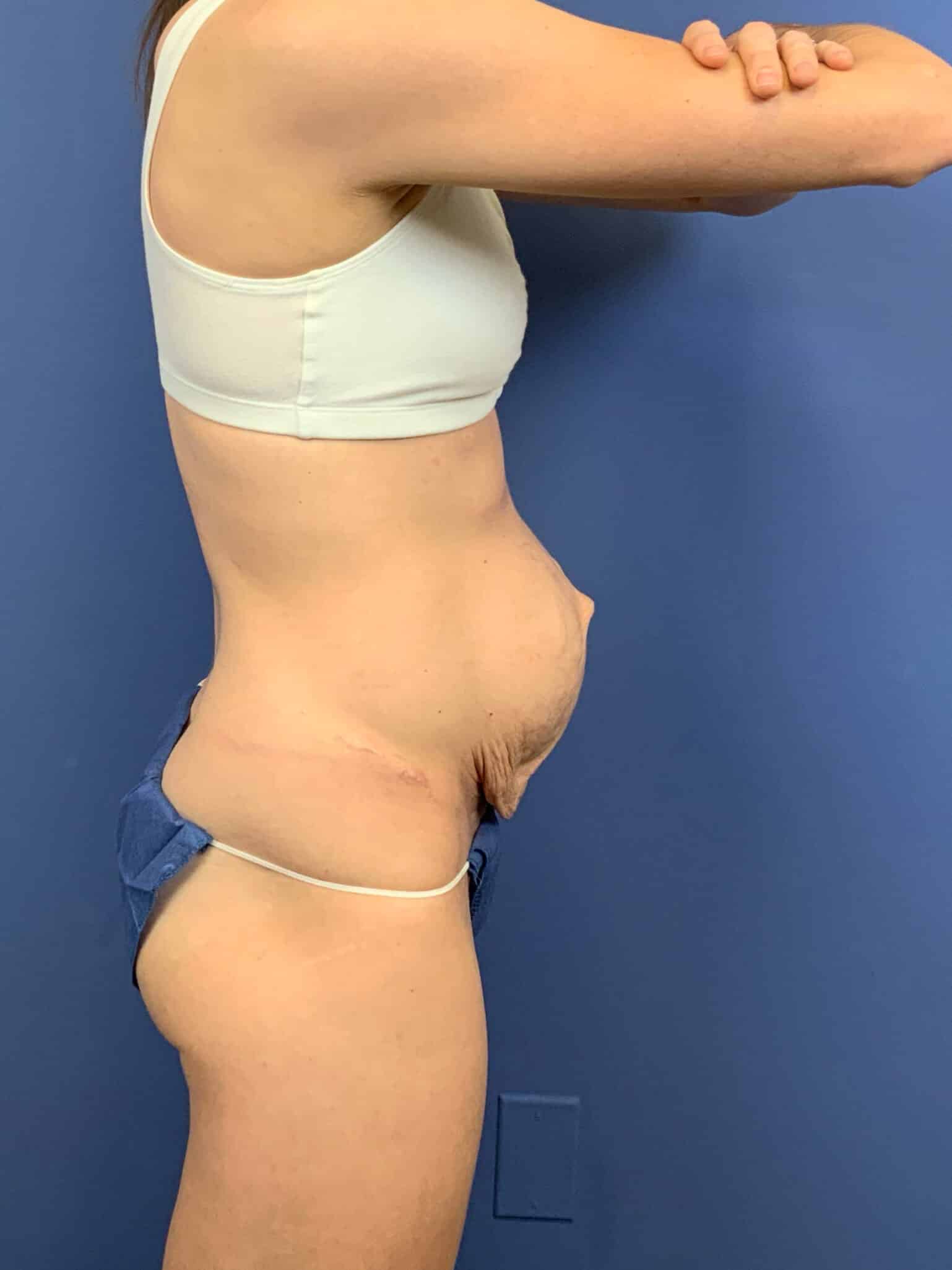 Before Image:  - right-side