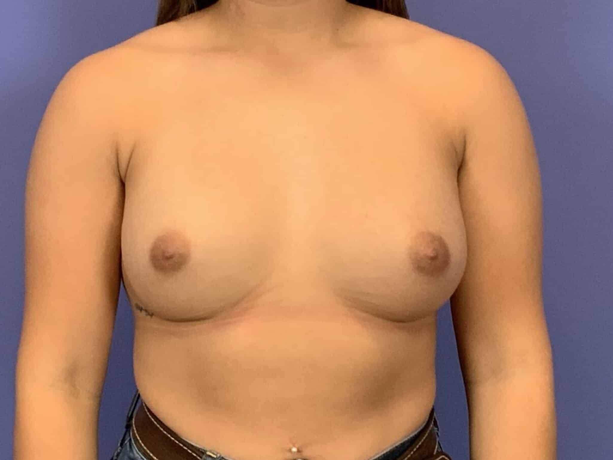 After Image:  - front