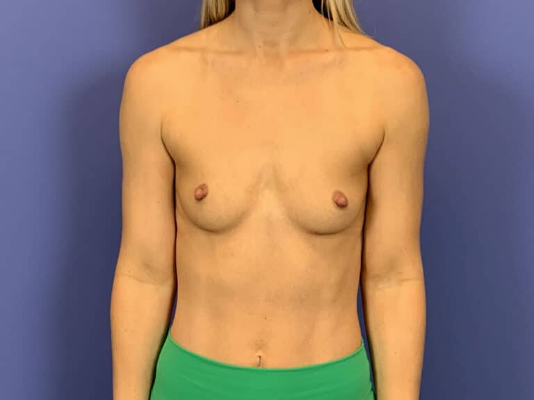 Before Image:  - front