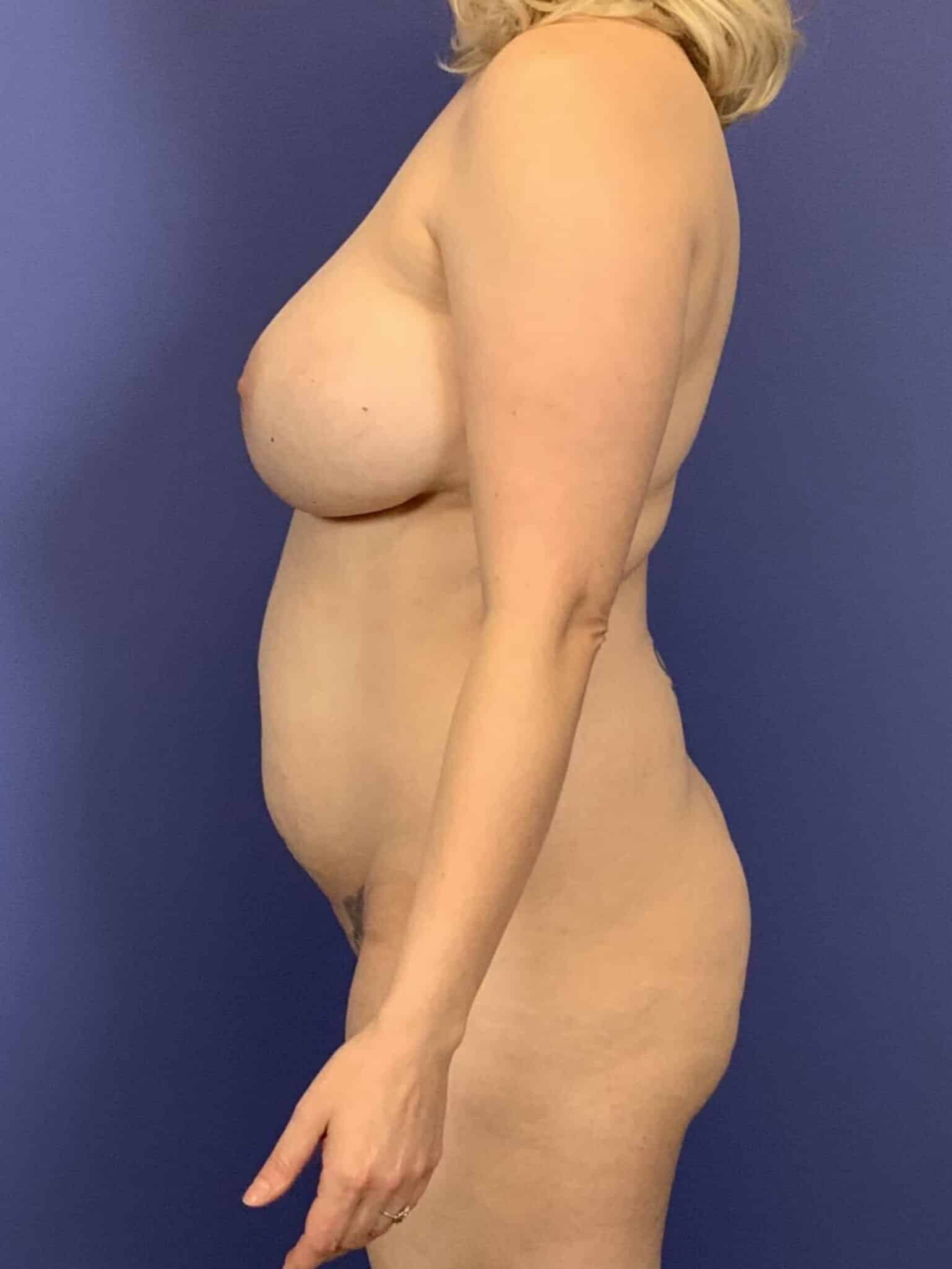 Before Image:  - left-side